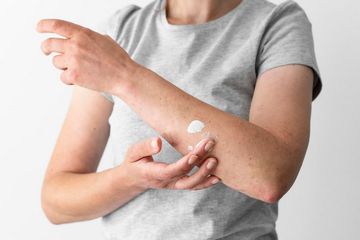 Banyak Ditanyakan Orang-orang, Apakah Ada Vaksin untuk Mencegah Mpox? 