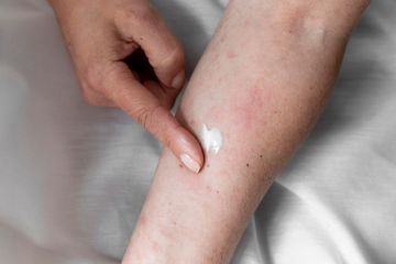 Pemberian Vaksin Mpox Mulai Dilakukan, Kemenkes Utamakan Orang-orang dengan Kondisi Ini