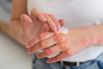 Awas Virus Mpox Mudah Menyebar, Ini Cara Tepat Pencegahan Cacar Monyet