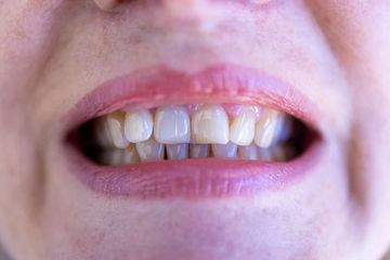 5 Cara Mengatasi Gigi yang Sakit Saat Mengunyah, Coba Kumur dengan Bahan Alami Berikut