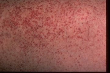 Petechiae