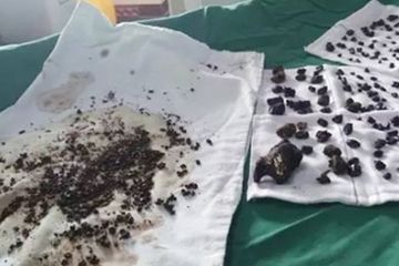 Akibat lalai sarapan batu-batu seperti ini berada di perut.