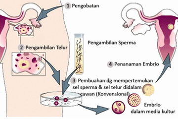Proses bayi tabung 