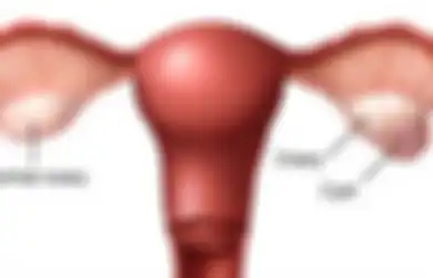 Nyeri Perut Tak Kunjung Sembuh,  Ternyata Kista Ovarium Sebesar 18 Kg Tumbuh di Perut Wanita India Ini Sampai Sulit Napas
