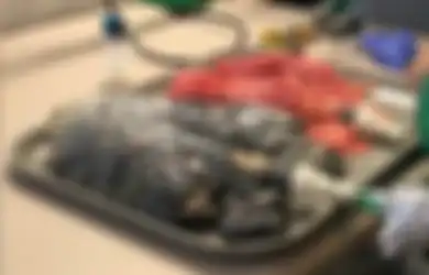Pakai Vape Selama 2 Tahun, Paru-paru Pemuda 18 Tahun Ini Rusak: Bandingkan Dengan Kondisi Paru-paru Perokok Aktif Ini, Seram!