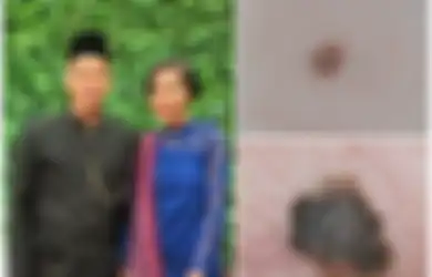 Adara Taista Meninggal Karena Kanker Melanoma: Ini Penyebab dan Gejala dari Kanker Kulit Mematikan Tersebut