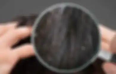 Coba Gunakan Ini pada Rambut Anda Bila Berketombe dan Lihat Hasilnya yang Mengejutkan!