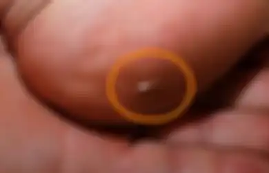 Bawang Merah Bisa Keluarkan Duri dari Kulit dengan Mudah, Ini Triknya