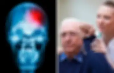 Jangan Panik, Ini Cara Mudah Mengenali Gejala Stroke dan Mengurangi Dampak Terburuknya