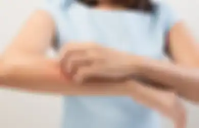 Tak Perlu Panik Saat Alami Biduran, Ini 3 Resep Obat Herbal yang Bisa Digunakan