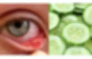 Mata Anda Bintitan? Cobalah Empat Obat Alami Pengusir Bintitan Ini, Bisa Sembuh Dalam Semalam