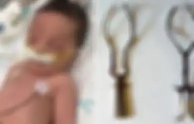 Kepala Bayi Ini Terputus Karena Persalinan Forsep, Siapa yang Salah Dalam Kasus Ini?