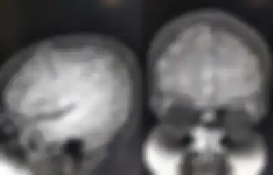 Kisah Orang-orang yang Tubuhnya Jadi Sarang Cacing Pita, Salah Satu Penyebabnya Sering Dianggap Sepele