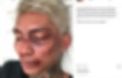 Young Lex Unggah Foto Babak Belur Dihajar K-Popers Garis Keras, Ternyata Semua Hanya HOAX