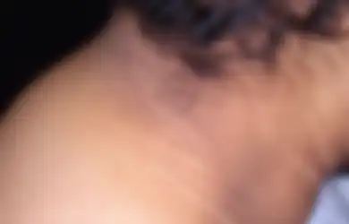 Kulit Leher Belakang Menebal dan Terlihat Hitam? Hati-hati Itu Tanda Penyakit-penyakit Ini Lho...