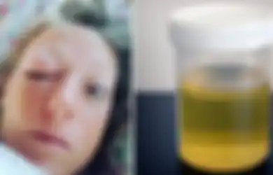Perempuan Ini Rutin Minum 2 Gelas Air Kencing Setelah Cairan Itu Berhasil Sembuhkan Bengkak di Matanya
