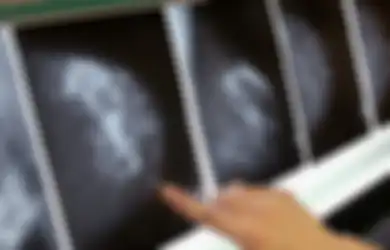 Dapat Donor Organ dari Orang yang Sama, 4 Pasien Ini Terkena Kanker Payudara bahkan Ada yang Sampai Meninggal