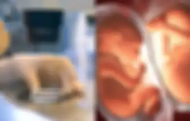 41 Tahun yang Lalu, Bayi Tabung Pertama di Dunia Lahir, Begini Sejarahnya