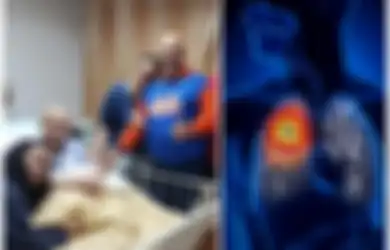 Istri Indro Warkop Meninggal Dunia: 6 Makanan Mudah Didapat yang Bisa Mengurangi Risiko Kanker Paru-paru