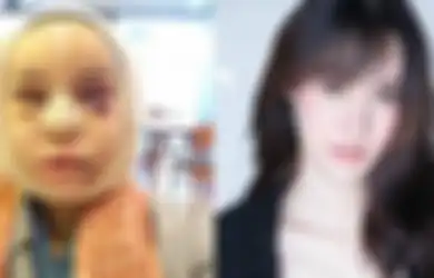 (Foto) Operasi Plastik Tak Seinstan yang Dibayangkan, Wajah Wanita Ini Bengkak Selama 3 Bulan Setelah Jalani Operasi