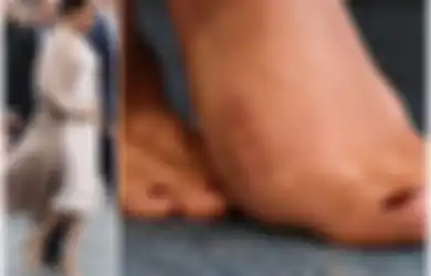Bertelanjang Kaki, Meghan Markle Disebut Pernah Operasi Karena Bunion, Apa Itu?