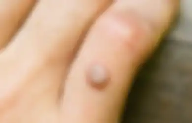 Tempelkan dengan Selotip! Ternyata Ada Manfaat Daun Dewa untuk Mengatasi Kutil, Masalah Kulit yang Sering Bikin Malu