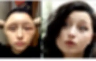 Alergi Pewarna Rambut, Bentuk Kepala Gadis Ini Berubah dan Ia Mengaku Hampir Mati