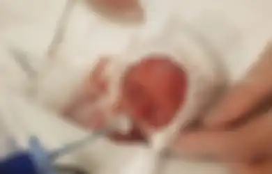 Lahir Seukuran Botol Kecap, Bayi Ini Kini Sudah Bisa Pulang untuk Sambut Natal Bersama Keluarganya