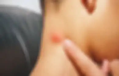 Miliki Benjolan di Beberapa Bagian Tubuh, Apakah Itu Tanda Infeksi atau Kanker? Begini Cara Mencari Tahunya