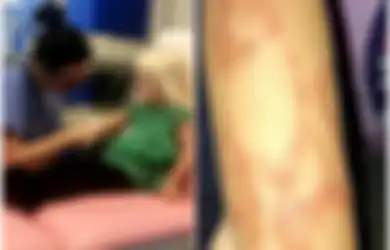 Seorang Anak Berteriak Kesakitan dan Gatal karena Tato Henna, Bekas Lukanya Berbentuk Kucing yang Membuat 'Cacat Permanen'