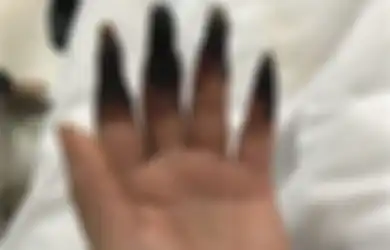 Jari-jarinya Berubah Menjadi Hitam Lebam Laiknya Membusuk, Penyakit Apa Ini?