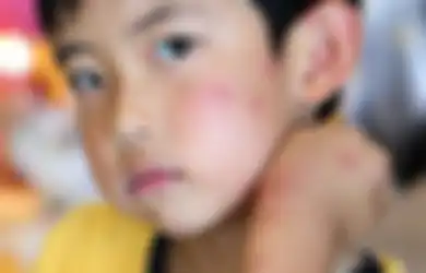 Berkenalan dengan Penyakit 'Darah Manis' yang Bikin Kulit Anak Mudah Bentol dan Luka