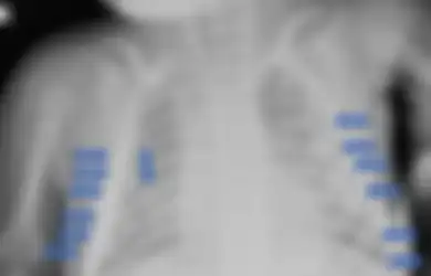 Disiksa oleh Orang Tuanya, Bayi 4 Bulan Ini Alami 28 Patah Tulang