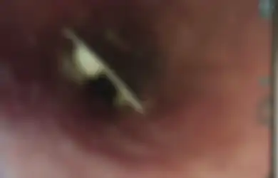 Wanita Ini Berulang Kali ke Rumah Sakit karena Tenggorokan Sakit, 17 Hari Kemudian Baru Ditemukan Sebuah Kemasan Obat di dalamnya