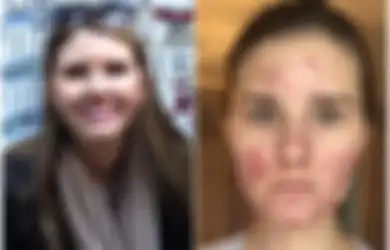 Wanita dengan Jerawat Kistik Tampil Tanpa Make up untuk Pertama Kalinya:  Apa itu Jerawat Kistik? Bagaimana Penyebarannya?