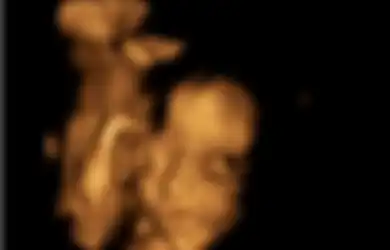 Bayi 24 Minggu Dikeluarkan dari Janin, Kemudian Dimasukkan Kembali ke dalam Kandungan, Ini Alasannya