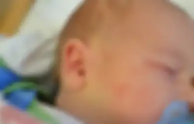 Obat Biduran pada Anak-anak, Jangan Khawatir! Ini Tips dari Ahli Kulit