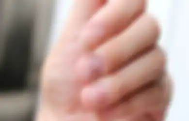 4 Kondisi Tangan Ini Dapat Tunjukkan Masalah Tiroid, Salah Satunya Kuku yang Rapuh 