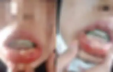Beli Kawat Gigi Murah dari Olshop, Wanita Ini Alami Demam Tinggi Hingga Bibir Jadi Bengkak