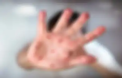 Kini Berstatus Keadaan Darurat Kesehatan Global, Ini yang Harus Dilakukan Orangtua Jika Anaknya Terkena Virus Cacar Monyet, 'Jangan Sampai Kasus Menjadi Parah'