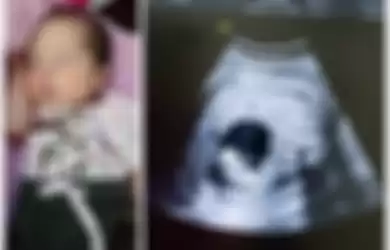 Bayi Itzamara lahir dengan mengandung janin kembarannya dalam kasus fetus in fetu.