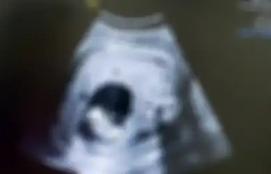 Bukan Bahagia, Wanita Ini Terkejut Ketika Melihat Hasil USG Karena Wujud Anaknya Seperti Ini