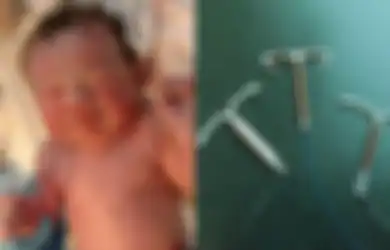 Viral Bayi Lahir dengan Menggenggam Alat KB Spiral Ibunya,  Alat KB Spiral Tak Efektif?