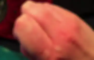 Obat Biduran di Apotek Ini Bisa Anda Beli Jika yang Alami Tak Mempan