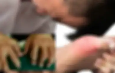 Ini yang Boleh dan Tidak Boleh Dimakan bagi Penderita Asam Urat, Termasuk Kopi dan Makanan Laut
