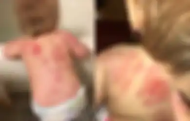 Ditemukan Lebih dari 25 Bekas Gigitan di Punggung Bayi Ini Setelah Ibunya Mengambilnya dari Tempat Penitipan Anak