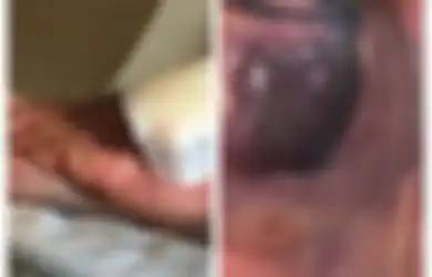 Ngeri, Terinfeksi Bakteri Pemakan Daging, Ada Benjolan Kehitaman di Tangan dan Kaki Pria Ini