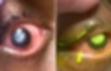 Mata dimakan bakteri karena tidur dengan lensa kontak.