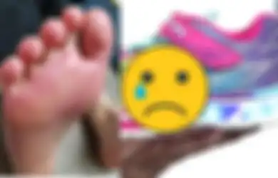 Gara-gara Sepatu Lampu yang Dipakainya, Kaki Bocah 9 Tahun Ini Alami Luka Mengerikan
