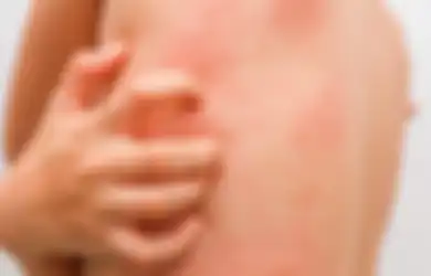 Biduran Karena Alergi? Ini 3 Obat Biduran Alami yang Bisa Anda Gunakan